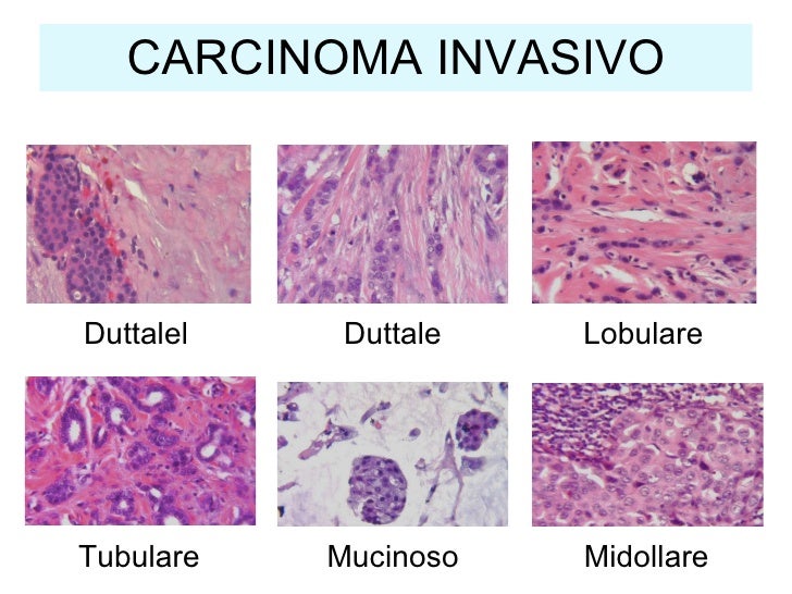 carcinoma mammario duttale carcinoma mammario duttale
